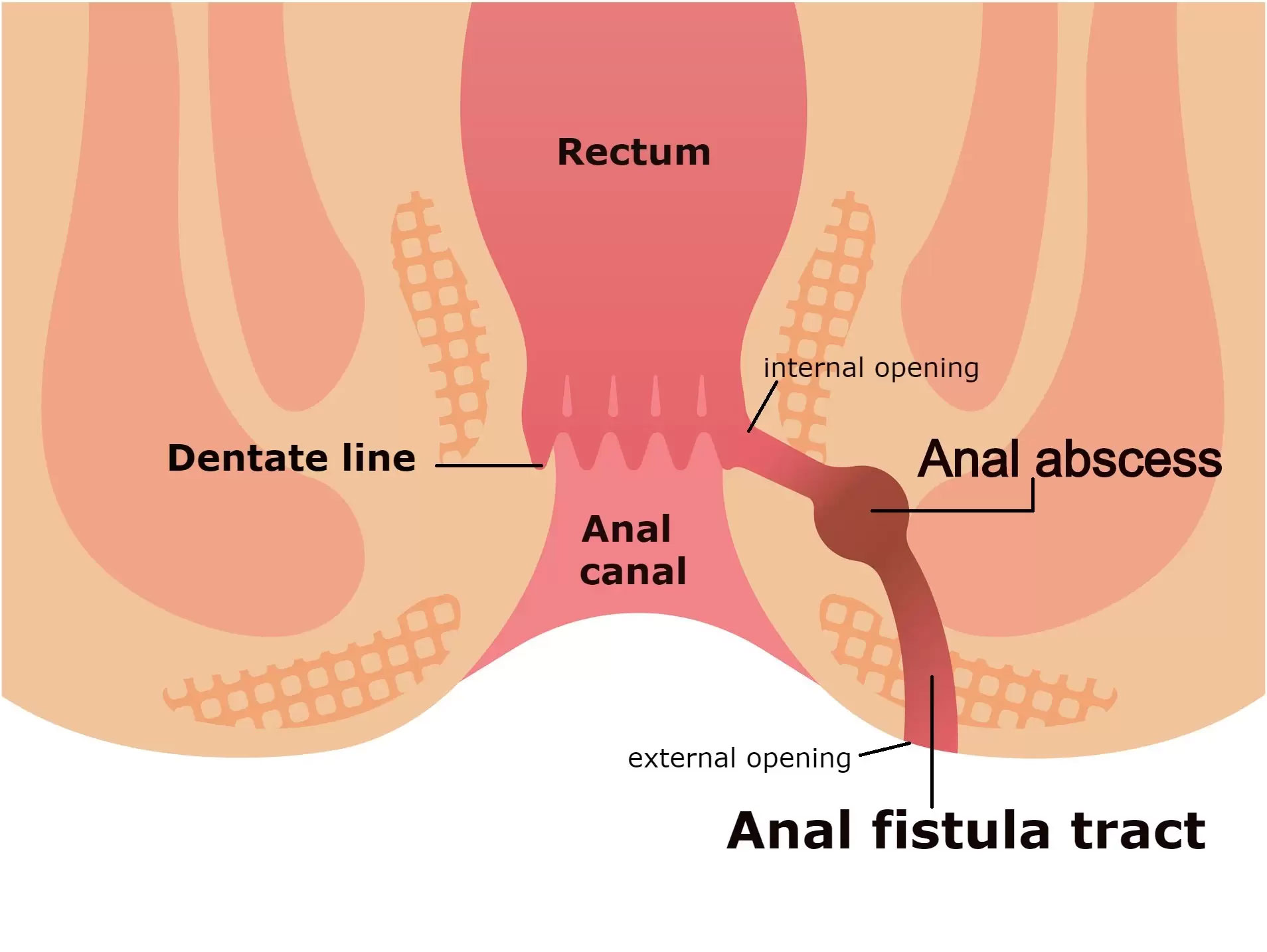 Anal Fistula